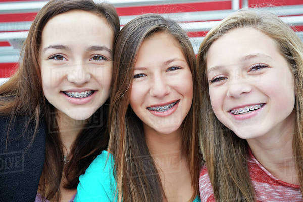 Teenage girls showing off braces together - Stock Photo - Dissolve