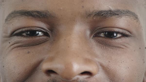smile lines on eyes