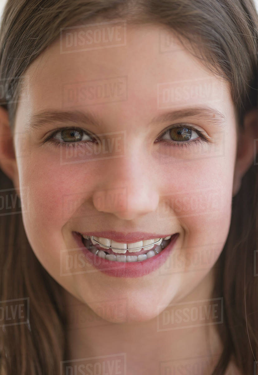 Girl (1011) wearing dental braces smiling Stock Photo Dissolve