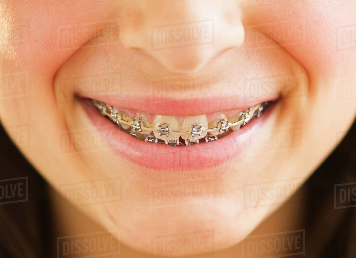 Closeup of girl's (1213) teeth braces Stock Photo Dissolve