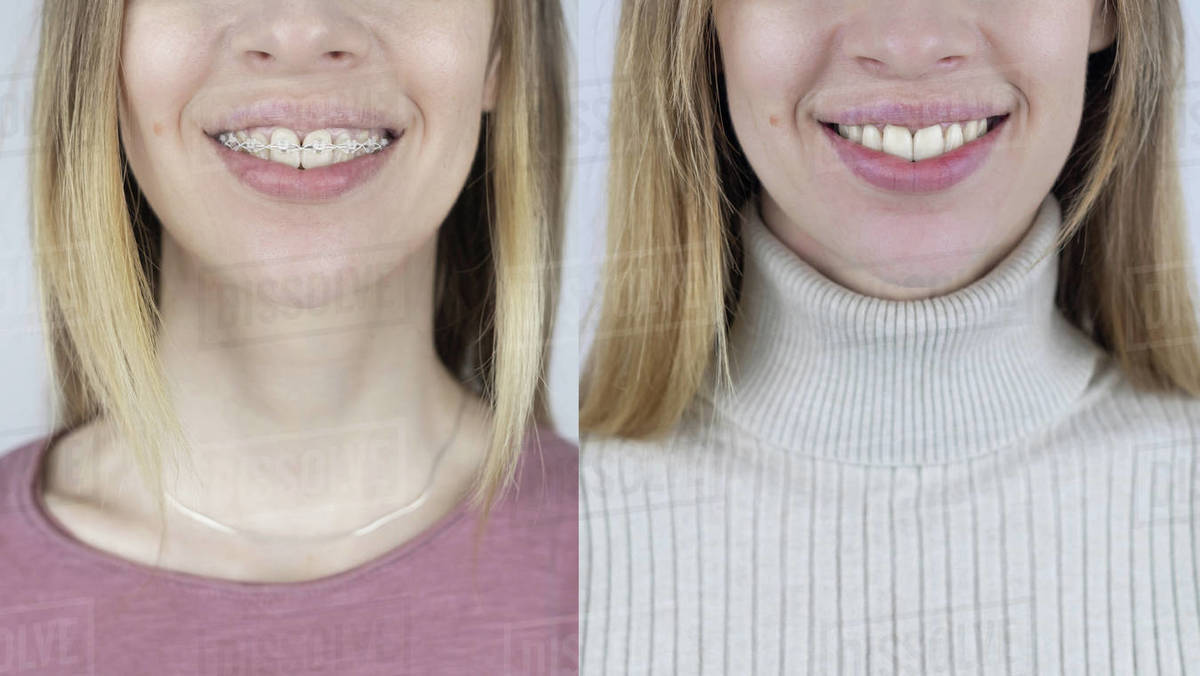 Before and after remove braces. On left is a girl in a metal bracket