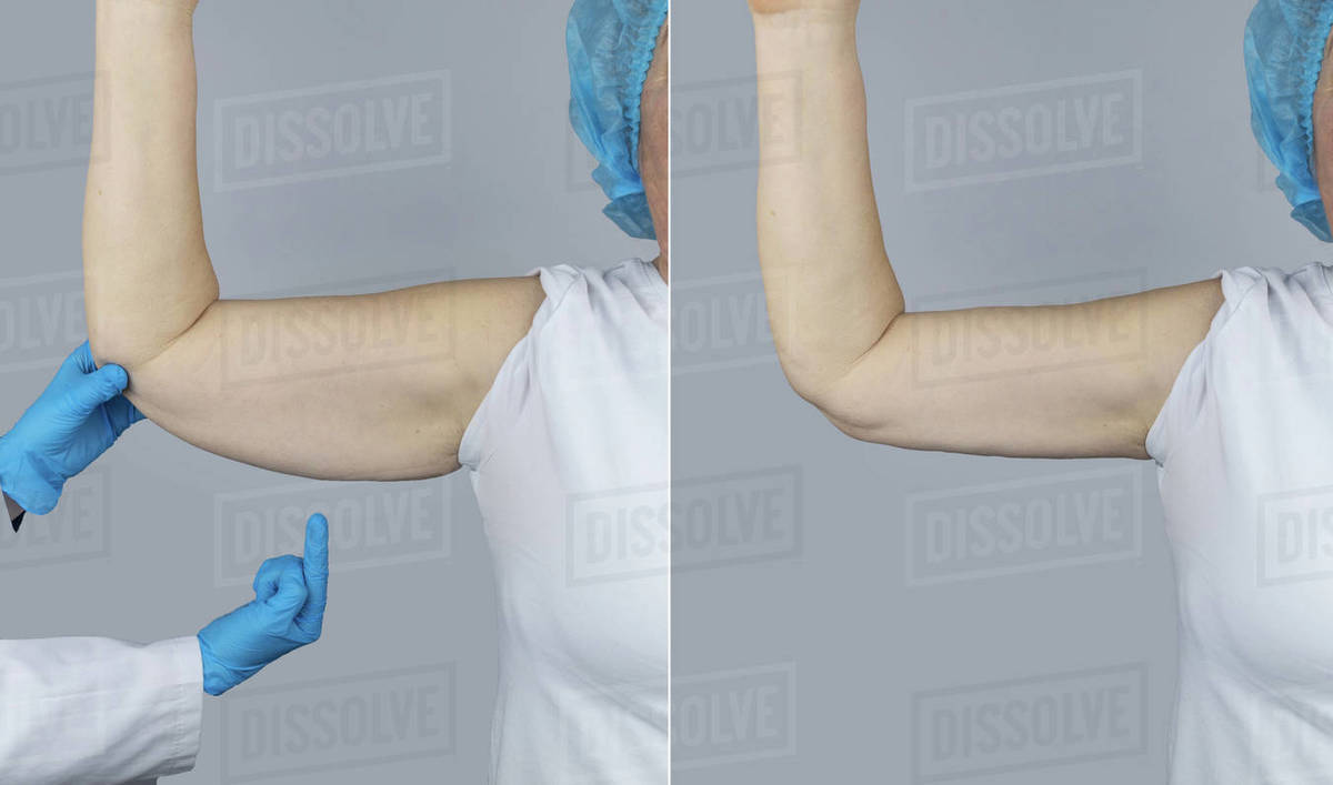 Before and after. Brachioplasty. Plastic arms, dangling skin at the