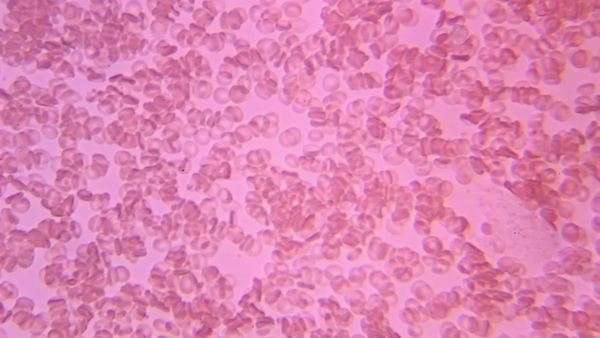 Microscopic view of human red blood cells and platelets clumping ...