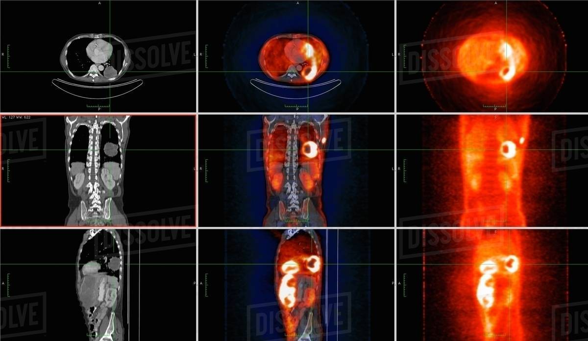 Image from coregistered PETCT study from dual modality scanner